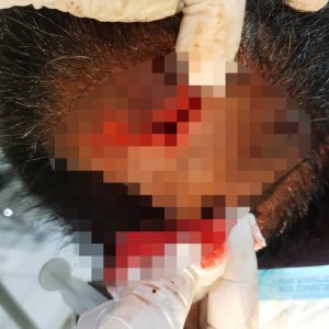 Luka sobek di kepala korban.